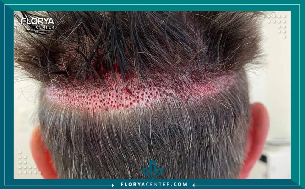 المنطقة المانحة في عملية زراعة الشعر 5 المنطقة المانحة في عملية زراعة الشعر