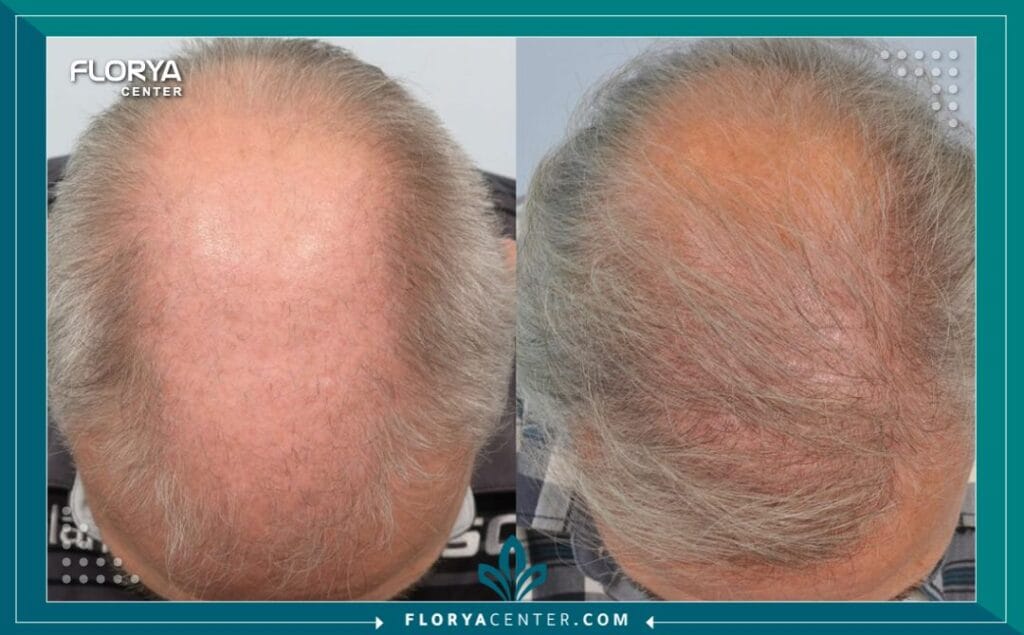 زراعة الشعر الطبيعي بالصور وتكلفة زراعة الشعر لعلاج الصلع