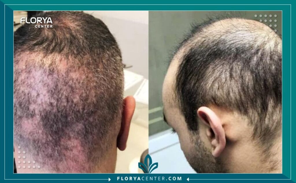 زراعة الشعر تعاريف ومصطلحات