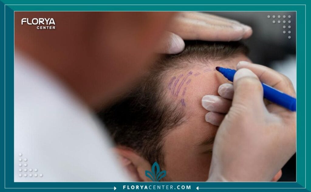 زراعة الشعر تعاريف ومصطلحات