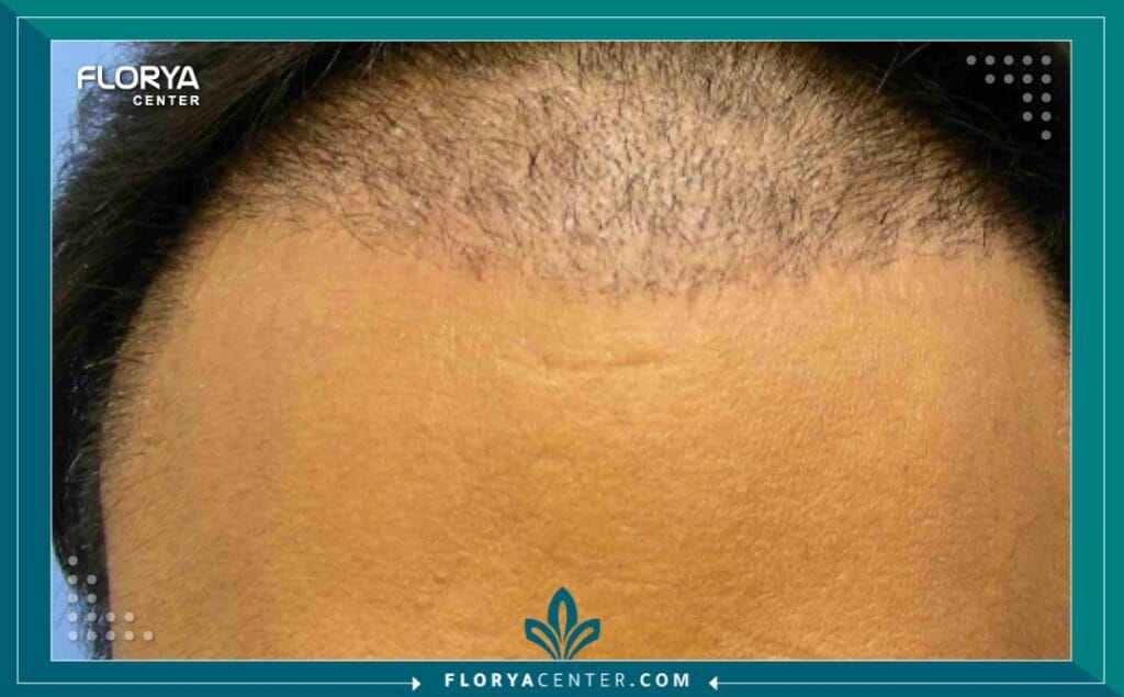 زراعة الشعر تعاريف ومصطلحات