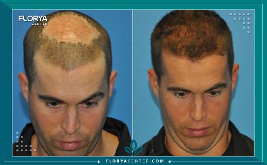 زراعة الشعر تعاريف ومصطلحات