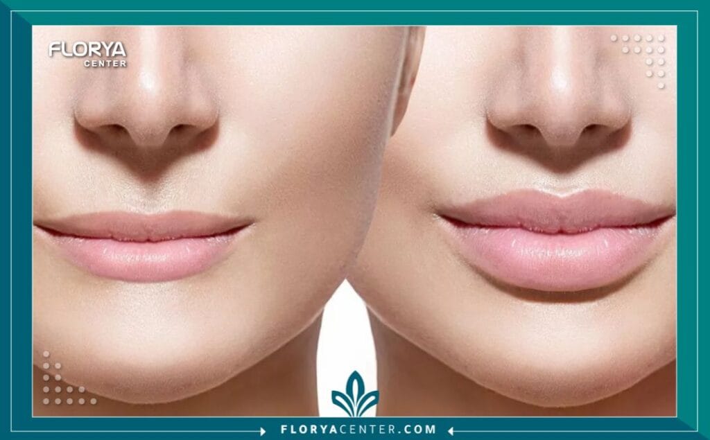 عملية تصغير الشفايف 3 عملية تصغير الشفايف