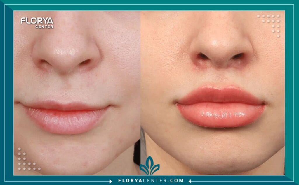 عملية تصغير الشفايف 4 عملية تصغير الشفايف