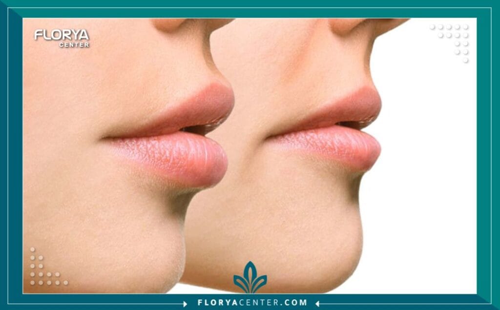 عملية تصغير الشفايف 5 عملية تصغير الشفايف