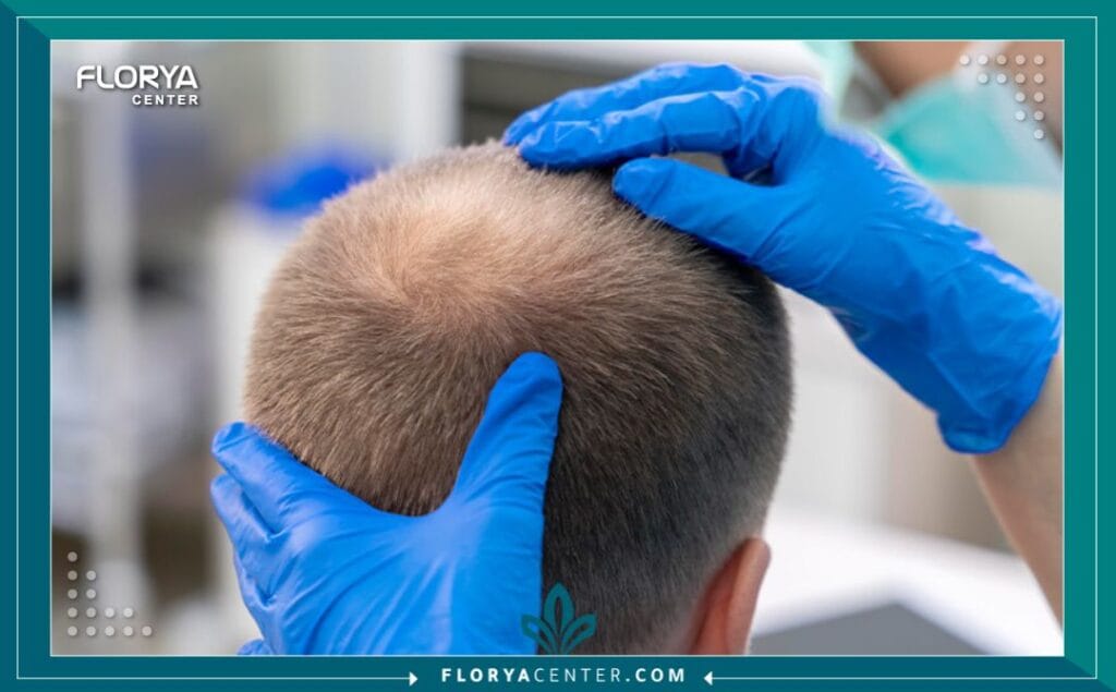 عملية زراعة الشعر الطبيعي