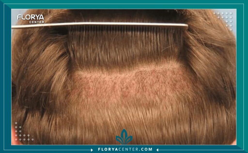 عملية زراعة الشعر الطبيعي