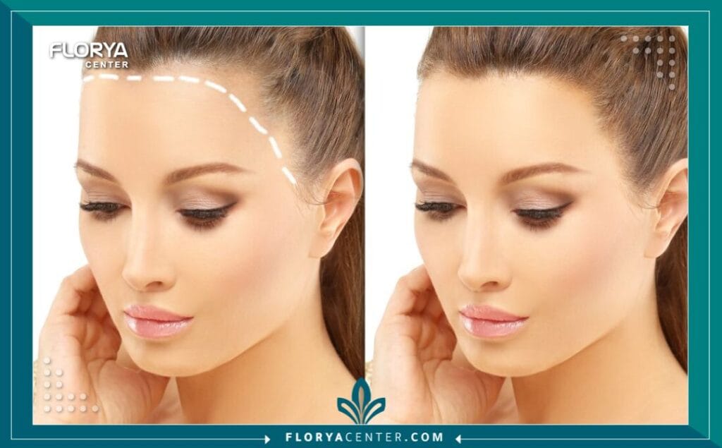 عملية زراعة الشعر الطبيعي