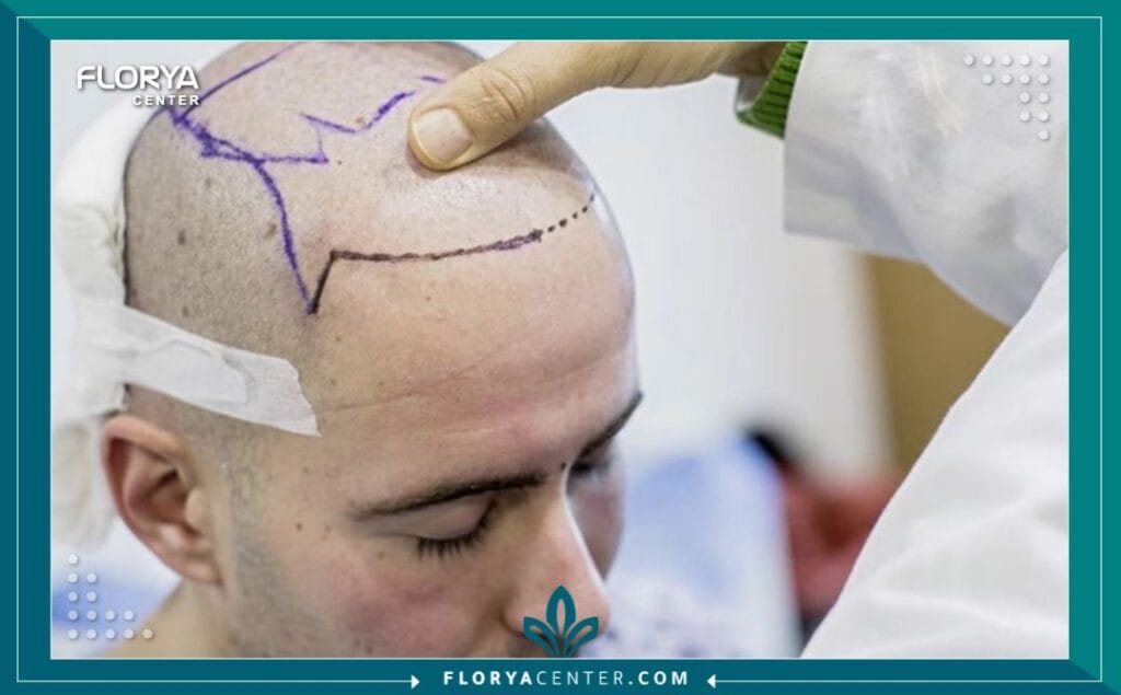 عملية زراعة الشعر الطبيعي