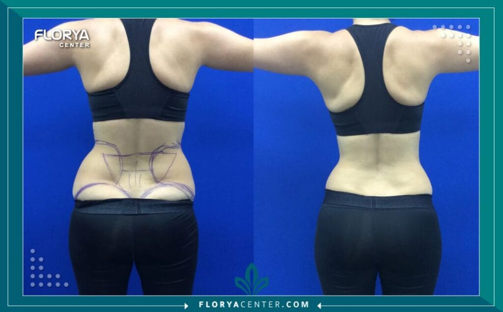 نحت الجسم بالليزر