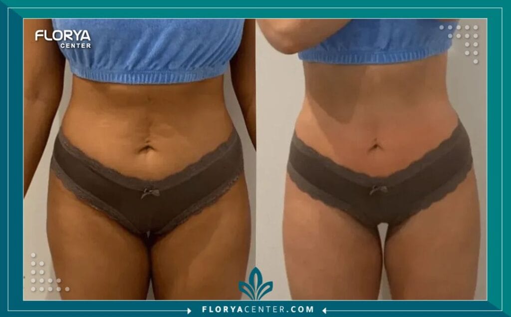 نحت الجسم بالليزر