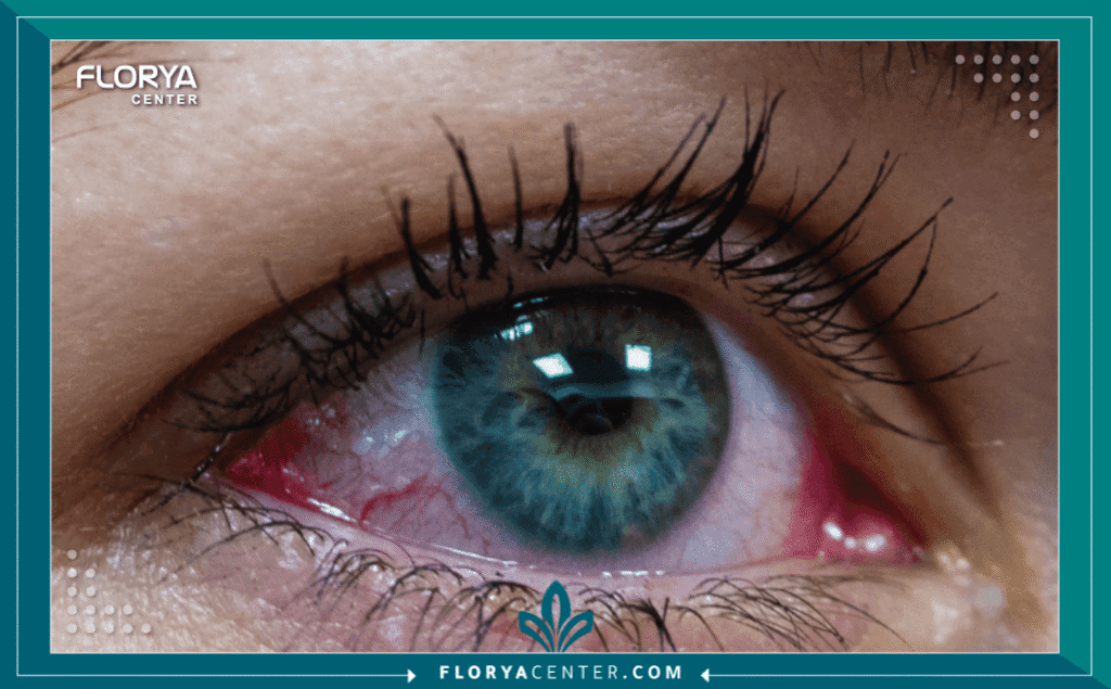 الجلوكوما (المياه الزرقاء - Glaucoma) 3 نسخة من Hayaalaje12 20250706 111750 ٠٠٠٠ - الجلوكوما (المياه الزرقاء - Glaucoma) تُعد الجلوكوما (المياه الزرقاء - Glaucoma) واحدة من أكثر أمراض العيون مكراً وفتكاً بحاسة البصر، حيث يُطلق عليها في الأوساط الطبية لقب "سارق البصر الصامت". تكمن خطورة هذا المرض في قدرته على تدمير العصب البصري بشكل تدريجي وبدون أعراض تحذيرية واضحة في مراحله الأولى، مما يؤدي إلى فقدان دائم للرؤية لا يمكن استعادته إذا لم يتم التدخل الطبي في الوقت المناسب. تشير الإحصاءات العالمية إلى أن الجلوكوما (المياه الزرقاء - Glaucoma) هي المسبب الثاني للعمى عالمياً، مما يجعل الفحص الدوري والوعي الطبي خط الدفاع الأول للحفاظ على جودة الحياة. في هذا الدليل التحليلي الشامل، سنغوص في أعماق المرض، ونستعرض أحدث البروتوكولات العلاجية المتوفرة في تركيا، وتحديداً في مركز فلوريا (Florya Center)، لضمان حصولك على الرعاية التي تستحقها.