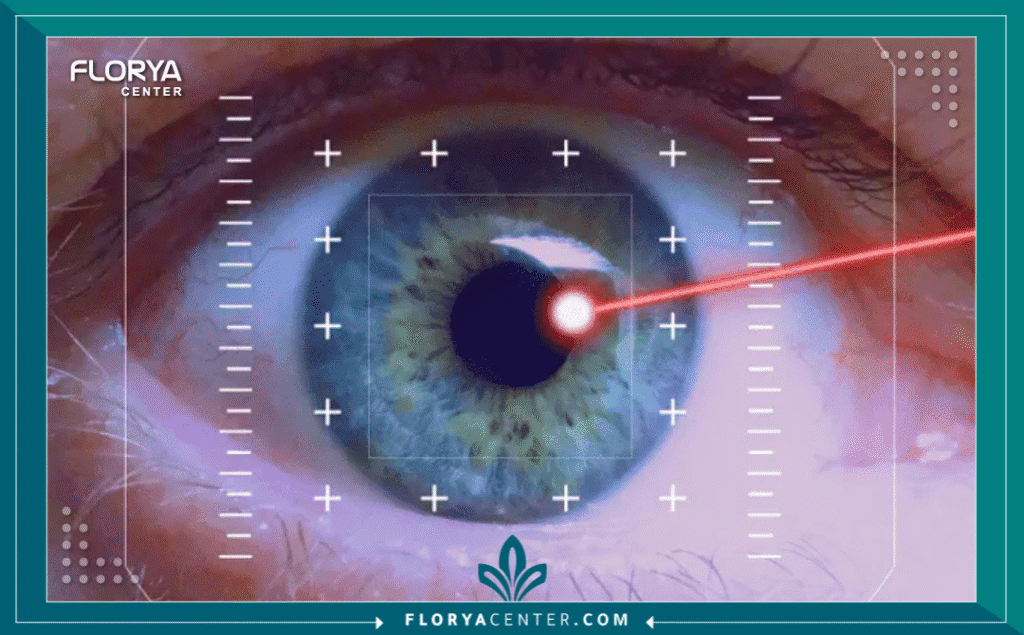 نسخة من Hayaalaje12 20250715 164326 ٠٠٠٠ - هل عملية الليزر مؤلمة؟ تعتبر المخاوف المتعلقة بالألم العائق النفسي الأول أمام الملايين الراغبين في التخلص من النظارات الطبية، حيث يتصدر سؤال "هل عملية الليزر مؤلمة؟" (Is Laser Eye Surgery Painful?) محركات البحث والعيادات الطبية على حد سواء. الحقيقة الطبية المختصرة هي أن الإجراء بحد ذاته غير مؤلم بفضل قطرات التخدير المتطورة، وأن ما يشعر به المريض هو مجرد "ضغط" لبضع ثوانٍ. ومع ذلك، فإن الإجابة الكاملة تتطلب تفصيلاً دقيقاً للفرق بين التقنيات المختلفة ومراحل التعافي، لضمان فهمك الكامل لما سيحدث داخل غرفة العمليات وخارجها.