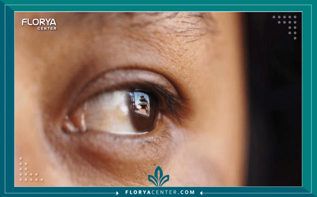 نسخة من Hayaalaje12 20250728 185638 ٠٠٠٠ - رواسب الكولسترول حول العين تُعتبر رواسب الكولسترول حول العين، المعروفة طبياً باسم (Xanthelasma Palpebrarum)، أكثر من مجرد مشكلة جمالية تؤرق الكثيرين؛ فهي قد تكون "الراية الصفراء" التي يرفعها الجسم للإشارة إلى وجود خلل في توازن الدهون داخله. في حين يسعى معظم المرضى لإزالة هذه اللويحات الصفراء البارزة لاستعادة صفاء نظرتهم وثقتهم بأنفسهم، يؤكد الأطباء على ضرورة التعامل معها بمنهجية تجمع بين الدقة التجميلية والوعي الصحي العميق. سواء كنت تفكر في الليزر، الجراحة، أو تبحث عن فهم أعمق للحالة، فإن هذا الدليل يضع بين يديك الحقائق الطبية المجردة.