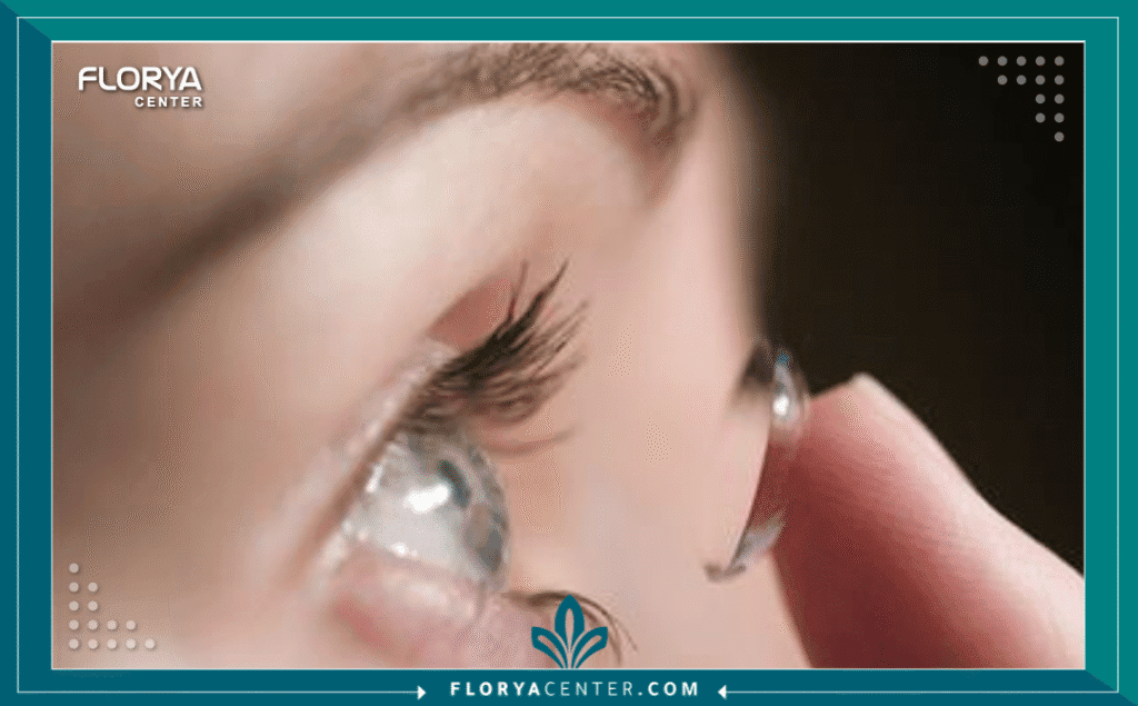 نسخة من Hayaalaje12 20250730 134222 ٠٠٠٠ 1 - كيف أختار نوع العدسة المناسب؟ يُعد قرار استبدال عدسة العين الطبيعية، سواء كان ذلك نتيجة لجراحة المياه البيضاء (Cataract) أو كإجراء لتصحيح النظر الانكساري (RLE)، نقطة تحول مفصلية في حياة المريض. إن السؤال الأكثر إلحاحاً الذي يواجهه المرضى في عيادات العيون اليوم هو: "كيف أختار نوع العدسة المناسب؟" لضمان أفضل جودة رؤية ممكنة مدى الحياة. لم يعد الأمر مقتصراً على إزالة العتامة فحسب، بل أصبح فنّاً طبياً دقيقاً يهدف إلى تصميم رؤية تتناغم مع أسلوب حياة الفرد.