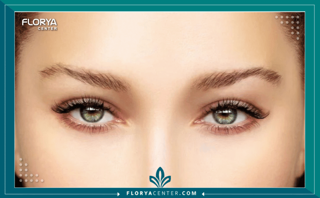 نسخة من Hayaalaje12 20250730 194503 ٠٠٠٠ 1 - مدة الشفاء بعد جراحة العيون تُعد مدة الشفاء بعد جراحة العيون (Recovery Time After Eye Surgery) الشغل الشاغل لكل مريض يخطط لاستعادة حدة إبصاره، سواء كان ذلك عبر تصحيح النظر بالليزر أو إزالة المياه البيضاء. في الواقع، إن مصطلح "الشفاء" في طب العيون لا يعني مجرد الخروج من غرفة العمليات، بل هو رحلة فسيولوجية دقيقة تبدأ من التئام الطبقة الطلائية للقرنية وصولاً إلى استقرار الانكسار الضوئي الكامل. وبينما قد يعود البعض لممارسة حياتهم الطبيعية خلال 24 ساعة، قد يحتاج آخرون لأسابيع لضمان ثبات النتائج. إن فهمك الدقيق لتفاصيل مدة الشفاء بعد جراحة العيون هو الخطوة الأولى لضمان عدم حدوث انتكاسات أو مضاعفات، وهو ما نركز عليه في مركز فلوريا (Florya Center) لضمان تجربة علاجية آمنة ومريحة.