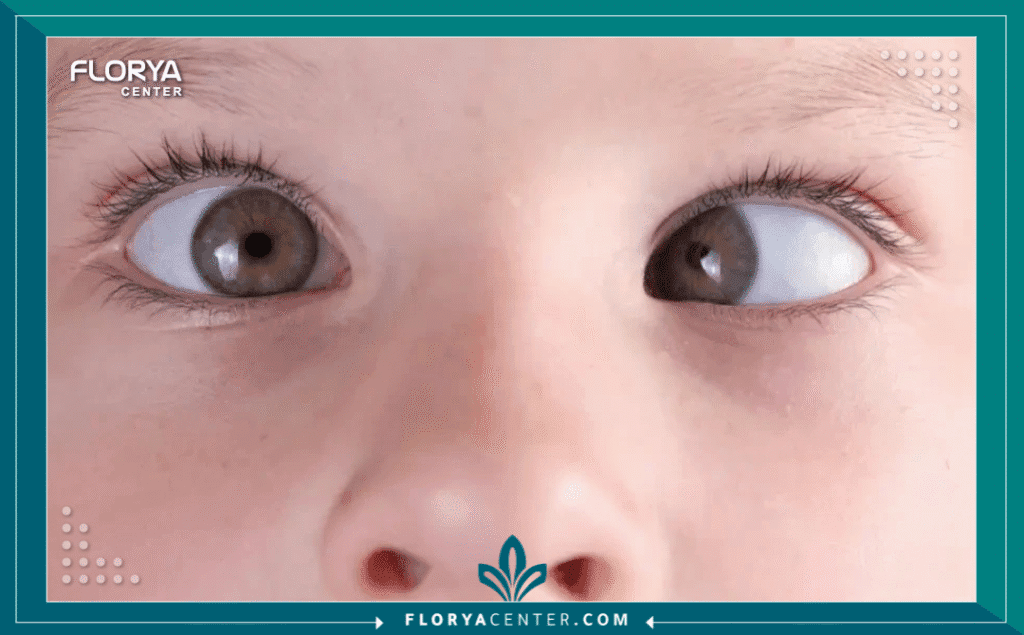 Hayaalaje12 20250706 161553 ٠٠٠٠ - طب عيون الأطفال والحول يُعد طب عيون الأطفال والحول (Pediatric Ophthalmology and Strabismus) من أكثر التخصصات الطبية دقة وحساسية، حيث لا يقتصر الهدف فيه على تصحيح النظر فحسب، بل يمتد ليشمل حماية التطور العصبي والدماغي للطفل. تشير الإحصاءات الطبية إلى أن اكتشاف مشاكل الإبصار في السنوات الأولى يمكن أن يمنع فقدان البصر الدائم بنسبة تصل إلى 95%. إن التدخل المبكر ليس خياراً ترفيهياً، بل هو ضرورة قصوى لضمان نمو بصري سليم، وتجنب مشاكل "الكسل البصري" التي قد تلازم الطفل مدى الحياة. في هذا الدليل الشامل، سنغوص في عمق التشخيص الدقيق والحلول الجراحية وغير الجراحية المتقدمة.