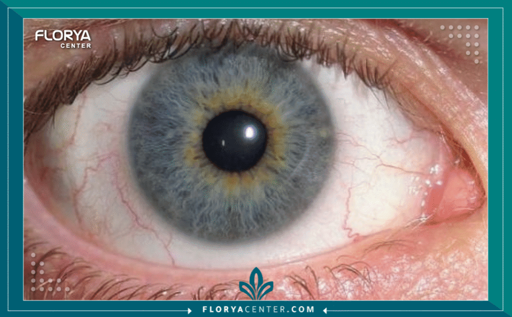 Hayaalaje12 20250706 213013 ٠٠٠٠ 2 - طب أعصاب العيون لا تقتصر عملية الرؤية على سلامة العين فحسب، بل هي عملية معقدة تبدأ في الشبكية وتنتهي في الفص القذالي للدماغ. هنا يبرز دور طب أعصاب العيون كحلقة وصل حيوية وحاسمة بين طب العيون وطب الأعصاب. يعاني العديد من المرضى من مشاكل بصرية غير مفسرة بوجود خلل في العين نفسها، ليتضح لاحقاً أن السبب يكمن في المسارات العصبية أو الدماغ. إن تخصص طب أعصاب العيون يتعامل مع هذه الحالات المعقدة التي قد تكون مؤشراً لأمراض جهازية خطيرة مثل التصلب اللويحي أو أورام الدماغ.