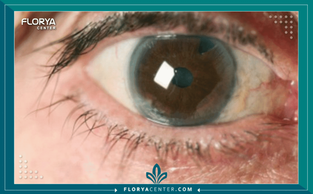 Hayaalaje12 20250718 233502 ٠٠٠٠ - هل كسل العين دائم؟ يواجه ملايين الأشخاص حول العالم تشخيص "الغمش" أو كسل العين (Amblyopia)، ويظل السؤال الأكثر رعباً الذي يتردد في أذهان الآباء والبالغين على حد سواء هو: هل كسل العين دائم؟ وهل يعني تجاوز سن الطفولة فقدان الأمل نهائياً في استعادة البصر؟ الإجابة المختصرة والتقليدية كانت "نعم" لسنوات طويلة، ولكن الطب الحديث يحمل إجابة مختلفة جذرياً وأكثر تعقيداً.