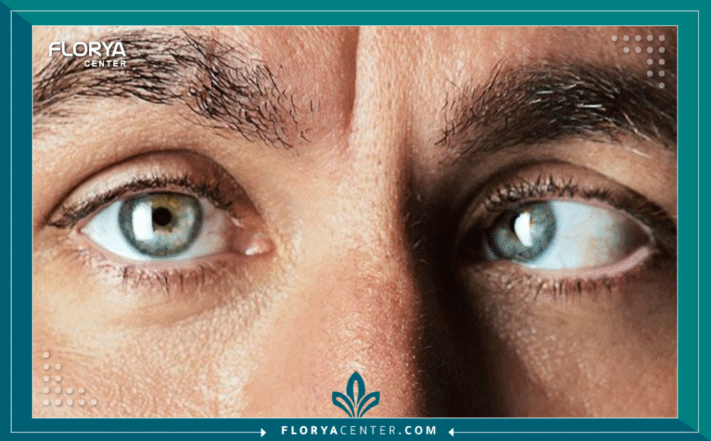 تكلفة عملية الحول في تركيا 2 Hayaalaje12 20250721 151700 ٠٠٠٠ 1 - تكلفة عملية الحول في تركيا عندما نتحدث عن تكلفة عملية الحول في تركيا (Cost of Strabismus Surgery in Turkey)، فنحن لا نتحدث مجرد إجراء جراحي روتيني، بل نتحدث عن استعادة "هوية نظراتك" وقدرتك على التواصل البصري بثقة. هل تساءلت يوماً عن الأسعار الدقيقة والمحدثة لعام 2026 بعيداً عن الأرقام التسويقية المضللة؟ إن جراحة عضلات العين تتطلب دقة متناهية للحفاظ على التناسق البصري والجمالي (Visual Identity)، وأي خطأ في الحسابات قد يؤدي إلى ازدواجية الرؤية أو مظهر غير طبيعي. هذا الدليل ليس مجرد سرد للأرقام، بل هو خريطتك الاستثمارية الآمنة لضمان حصولك على أفضل النتائج الطبية بأفضل قيمة ممكنة، مع تفاصيل حصرية من قلب غرف العمليات في إسطنبول.