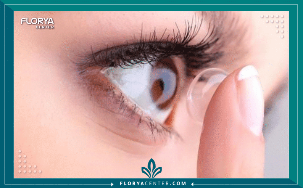 Hayaalaje12 20250725 214501 ٠٠٠٠ - العدسات لعلاج الانحراف تعتبر العدسات لعلاج الانحراف (Contact Lenses for Astigmatism) حجر الزاوية في طب العيون الحديث، حيث تقدم حلاً بصرياً متفوقاً للمرضى الذين يعانون من تشوش الرؤية الناتج عن عدم انتظام سطح القرنية. على عكس قصر أو طول النظر البسيط، يتطلب الانحراف (الاستجماتيزم) هندسة دقيقة لضمان استقرار العدسة داخل العين، وهو ما تفشل فيه العدسات التقليدية الكروية. إن اختيار العدسات لعلاج الانحراف الصحيحة لا يقتصر فقط على تصحيح النظر، بل يمتد ليشمل تحسين جودة الحياة، التخلص من تشوهات الرؤية الجانبية التي تسببها النظارات، وتوفير حدة إبصار عالية الدقة حتى في ظروف الإضاءة المنخفضة.