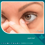 أورام العيون