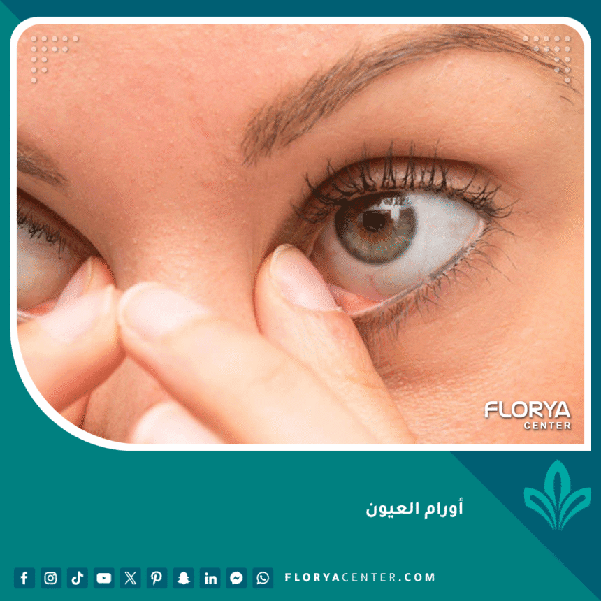 أورام العيون