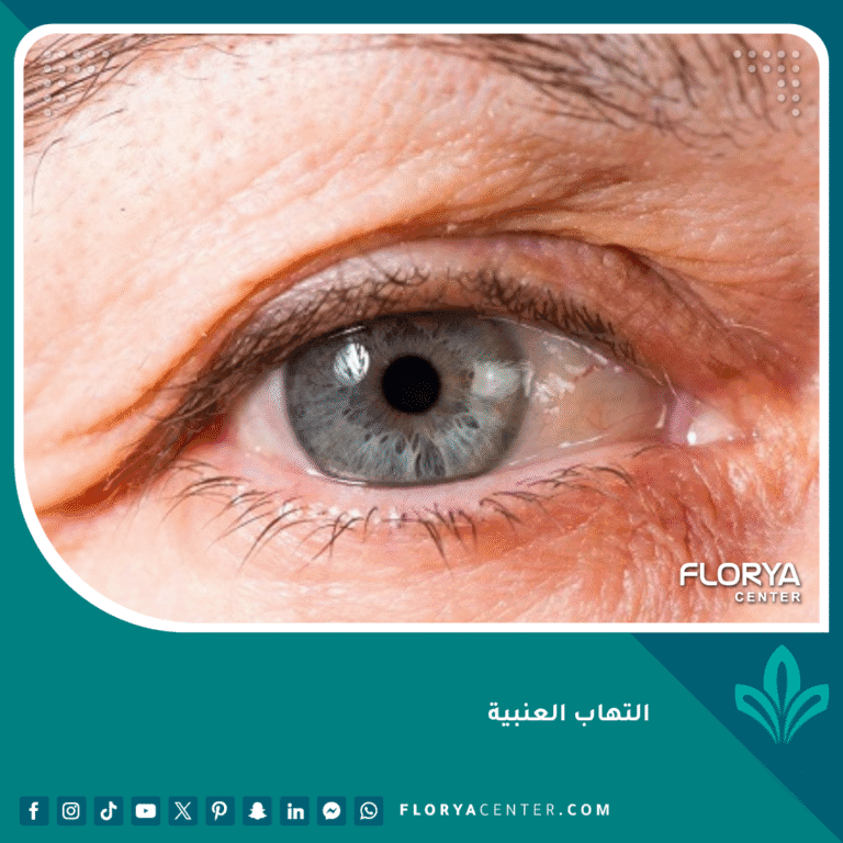 التهاب العنبية