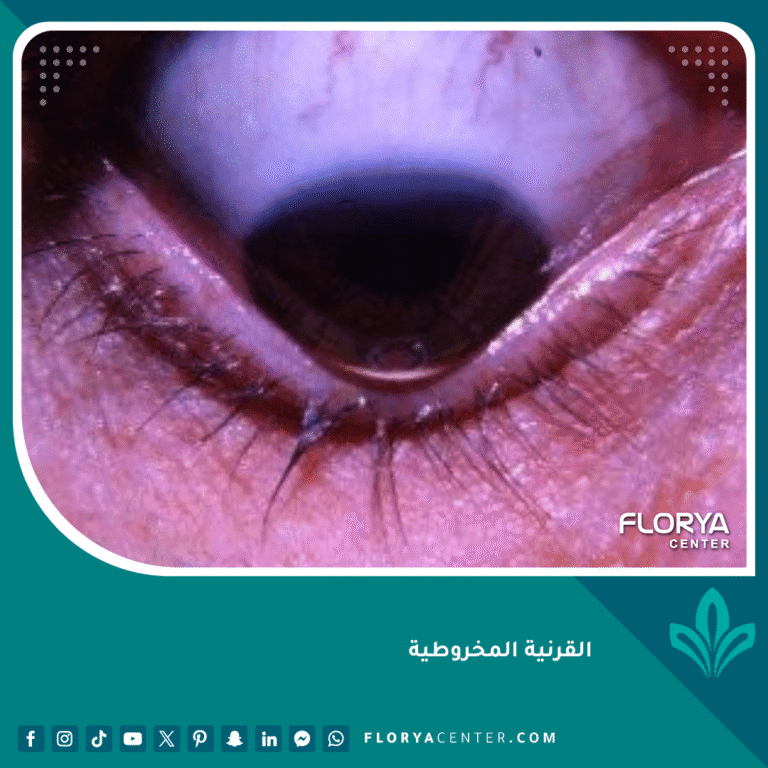 القرنية المخروطية
