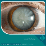 مرض المياه البيضاء