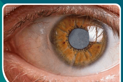 علاج المياه البيضاء بدون جراحة