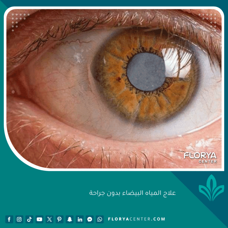 علاج المياه البيضاء بدون جراحة