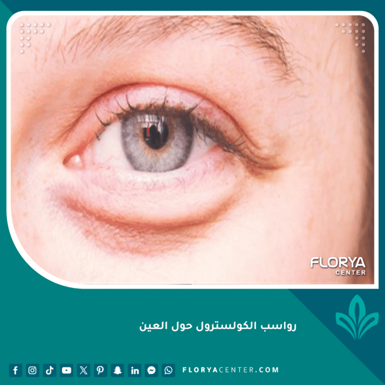 رواسب الكولسترول حول العين