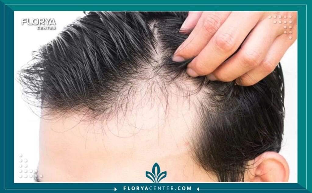 a1 5 - عروض باقات زراعة الشعر شاملة الإقامة لم تعد جراحة استعادة الشعر مجرد إجراء طبي دقيق (Micro-surgical procedure) يتم داخل غرفة العمليات فحسب، بل تحولت إلى تجربة متكاملة تتطلب تخطيطاً لوجستياً وطبياً محكماً لضمان أعلى درجات النجاح والراحة. في السنوات الأخيرة، أصبحت تركيا الوجهة العالمية الأولى لهذا الإجراء، ويعزى ذلك بشكل كبير إلى توفر عروض باقات زراعة الشعر شاملة الإقامة التي تضمن للمريض بيئة استشفائية مثالية. إن اختيار المريض الذكي لا يعتمد فقط على مهارة الجراح، بل على جودة "البيئة المحيطة" بالعملية، من لحظة الوصول إلى المطار وحتى المغادرة.