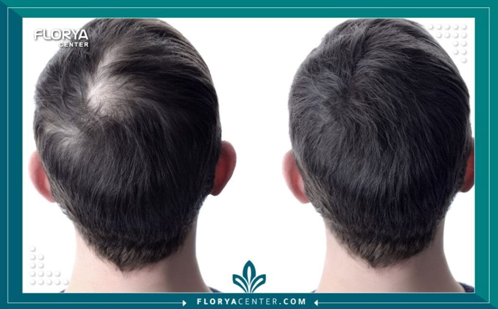 a2 5 - عروض باقات زراعة الشعر شاملة الإقامة لم تعد جراحة استعادة الشعر مجرد إجراء طبي دقيق (Micro-surgical procedure) يتم داخل غرفة العمليات فحسب، بل تحولت إلى تجربة متكاملة تتطلب تخطيطاً لوجستياً وطبياً محكماً لضمان أعلى درجات النجاح والراحة. في السنوات الأخيرة، أصبحت تركيا الوجهة العالمية الأولى لهذا الإجراء، ويعزى ذلك بشكل كبير إلى توفر عروض باقات زراعة الشعر شاملة الإقامة التي تضمن للمريض بيئة استشفائية مثالية. إن اختيار المريض الذكي لا يعتمد فقط على مهارة الجراح، بل على جودة "البيئة المحيطة" بالعملية، من لحظة الوصول إلى المطار وحتى المغادرة.