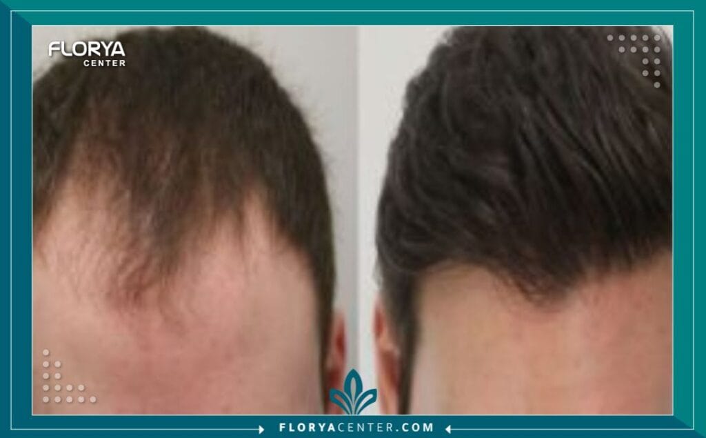 a3 5 - عروض باقات زراعة الشعر شاملة الإقامة لم تعد جراحة استعادة الشعر مجرد إجراء طبي دقيق (Micro-surgical procedure) يتم داخل غرفة العمليات فحسب، بل تحولت إلى تجربة متكاملة تتطلب تخطيطاً لوجستياً وطبياً محكماً لضمان أعلى درجات النجاح والراحة. في السنوات الأخيرة، أصبحت تركيا الوجهة العالمية الأولى لهذا الإجراء، ويعزى ذلك بشكل كبير إلى توفر عروض باقات زراعة الشعر شاملة الإقامة التي تضمن للمريض بيئة استشفائية مثالية. إن اختيار المريض الذكي لا يعتمد فقط على مهارة الجراح، بل على جودة "البيئة المحيطة" بالعملية، من لحظة الوصول إلى المطار وحتى المغادرة.