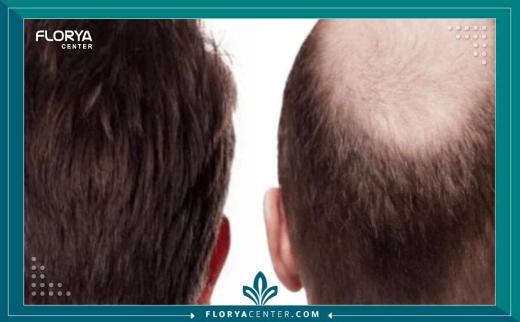 a4 5 - عروض باقات زراعة الشعر شاملة الإقامة لم تعد جراحة استعادة الشعر مجرد إجراء طبي دقيق (Micro-surgical procedure) يتم داخل غرفة العمليات فحسب، بل تحولت إلى تجربة متكاملة تتطلب تخطيطاً لوجستياً وطبياً محكماً لضمان أعلى درجات النجاح والراحة. في السنوات الأخيرة، أصبحت تركيا الوجهة العالمية الأولى لهذا الإجراء، ويعزى ذلك بشكل كبير إلى توفر عروض باقات زراعة الشعر شاملة الإقامة التي تضمن للمريض بيئة استشفائية مثالية. إن اختيار المريض الذكي لا يعتمد فقط على مهارة الجراح، بل على جودة "البيئة المحيطة" بالعملية، من لحظة الوصول إلى المطار وحتى المغادرة.