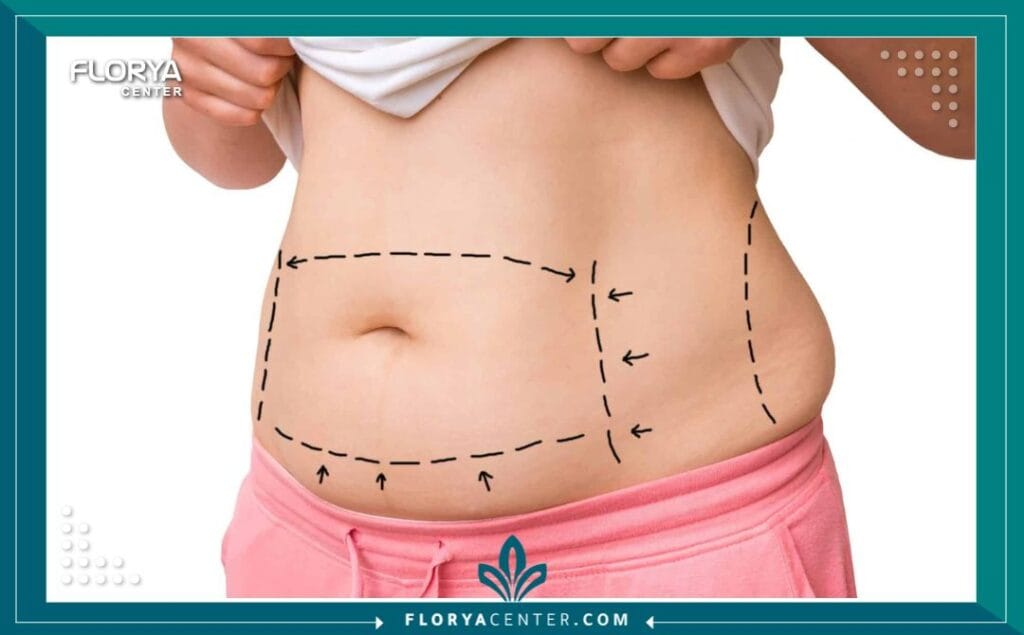 bb1 2 - شد البطن في اسطنبول في السعي نحو استعادة الثقة وتناسق القوام، برزت عملية شد البطن في اسطنبول Tummy tuck in Istanbul كواحدة من أكثر الإجراءات التجميلية الجراحية طلباً وفعالية على مستوى العالم. لم يعد الحصول على بطن مسطح ومشدود حلماً بعيد المنال، خاصة بعد التغيرات الكبيرة التي قد تطرأ على الجسم نتيجة الحمل المتكرر، أو فقدان الوزن الكبير، أو حتى تأثيرات الشيخوخة الطبيعية. تُعرف هذه العملية عالمياً باسم (Abdominoplasty)، وهي تمثل الحل الجذري للجلد الزائد والدهون العنيدة التي لا تستجيب للتمارين الرياضية أو الحميات الغذائية.