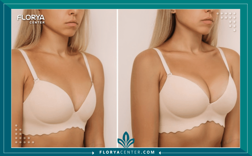 تكبير الثدي في تركيا 3 nouralagee93@gmail.com 20250711 142305 ٠٠٠٠ - تكبير الثدي في تركيا تُعد عملية تكبير الثدي في تركيا (Breast Augmentation) واحدة من أكثر الإجراءات التجميلية طلباً على مستوى العالم، حيث تجمع بين التطور الطبي الهائل والنتائج الجمالية الدقيقة. تسعى الآلاف من السيدات سنوياً لاختيار تكبير الثدي في تركيا كوجهة علاجية أولى، نظراً لما توفره الدولة من بنية تحتية طبية متقدمة تضاهي المعايير الأوروبية والأمريكية. إن القرار بالخضوع لهذا الإجراء لا يقتصر فقط على تحسين المظهر الخارجي، بل يمتد ليشمل تعزيز الثقة بالنفس وتصحيح التناظر الجسدي، وهو ما نركز عليه بدقة في "مركز فلوريا" لضمان تحقيق تطلعات المريضات بأعلى درجات الأمان.