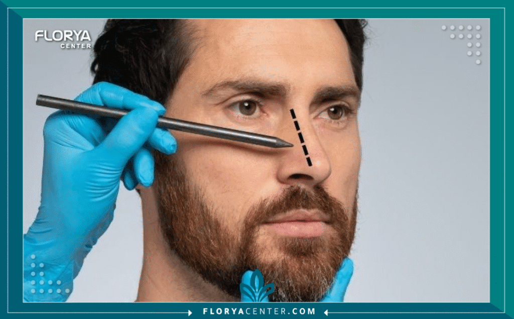 nouralagee93@gmail.com 20250713 121308 ٠٠٠٠ - نتيجة جراحة تجميل الأنف النهائية تُعد نتيجة جراحة تجميل الأنف النهائية هي المحرك الأساسي والهاجس الأول لكل من يقبل على إجراء هذا التغيير الجذري في ملامح الوجه. إن عملية تجميل الأنف (Rhinoplasty) ليست مجرد إجراء جراحي بسيط، بل هي رحلة فنية وطبية دقيقة تهدف إلى إعادة تشكيل الغضاريف والعظام لتحقيق التناغم المفقود. يسعى المرضى دائماً للوصول إلى نتيجة جراحة تجميل الأنف النهائية التي تضمن لهم تنفساً سليماً ومظهراً جمالياً متناسقاً يعزز من ثقتهم بأنفسهم.