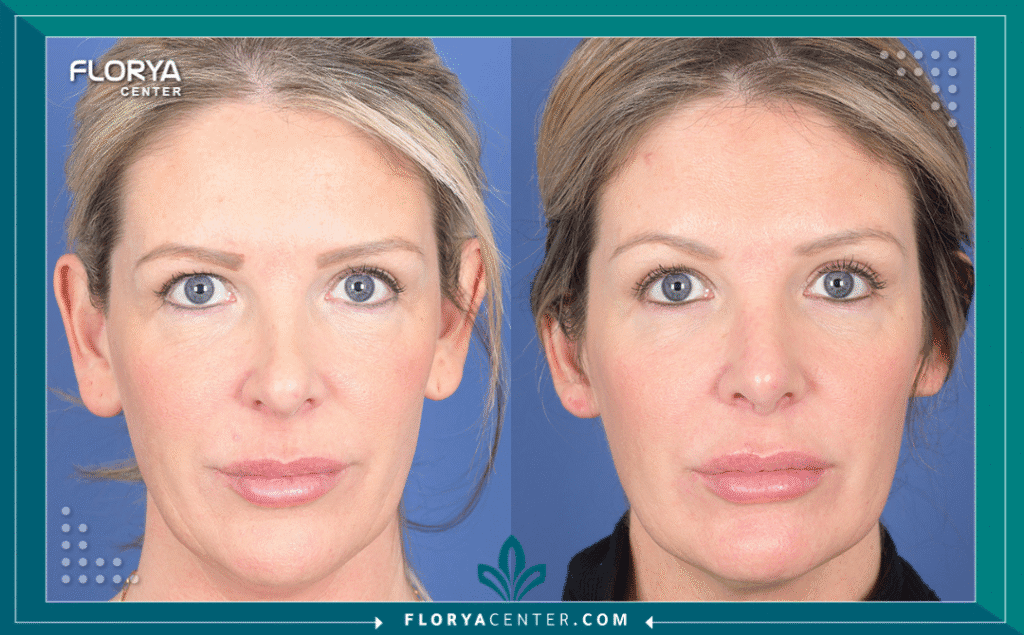 nouralagee93@gmail.com 20250713 121447 ٠٠٠٠ - نتيجة جراحة تجميل الأنف النهائية تُعد نتيجة جراحة تجميل الأنف النهائية هي المحرك الأساسي والهاجس الأول لكل من يقبل على إجراء هذا التغيير الجذري في ملامح الوجه. إن عملية تجميل الأنف (Rhinoplasty) ليست مجرد إجراء جراحي بسيط، بل هي رحلة فنية وطبية دقيقة تهدف إلى إعادة تشكيل الغضاريف والعظام لتحقيق التناغم المفقود. يسعى المرضى دائماً للوصول إلى نتيجة جراحة تجميل الأنف النهائية التي تضمن لهم تنفساً سليماً ومظهراً جمالياً متناسقاً يعزز من ثقتهم بأنفسهم.