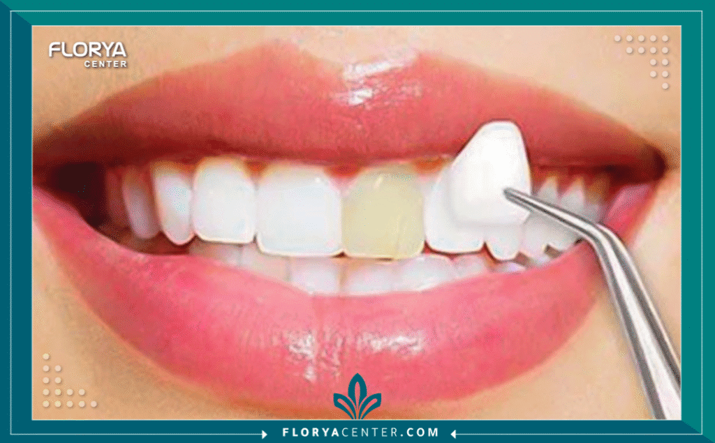 nouralagee93@gmail.com 20250714 102817 ٠٠٠٠ - فينير الأسنان يُعد فينير الأسنان (Dental Veneers) الحل التجميلي الأكثر طلباً وثورية في عالم طب الأسنان الحديث، فهو يمثل الطريق الأسرع والأكثر فعالية للحصول على ابتسامة متناسقة، ناصعة البياض، وجذابة، والتي تُعرف عالمياً باسم "ابتسامة هوليوود". لا يقتصر دور فينير الأسنان على تبييض الأسنان فحسب، بل هو إجراء دقيق يعيد نحت وتصميم شكل الابتسامة بالكامل، مما يمنحك تغييراً جذرياً في مظهرك وثقتك بنفسك. سواء كنت تعاني من تصبغات عميقة، أسنان غير متساوية، فراغات بسيطة، أو تشققات، فإن فينير الأسنان يقدم حلاً دائماً وفعالاً.