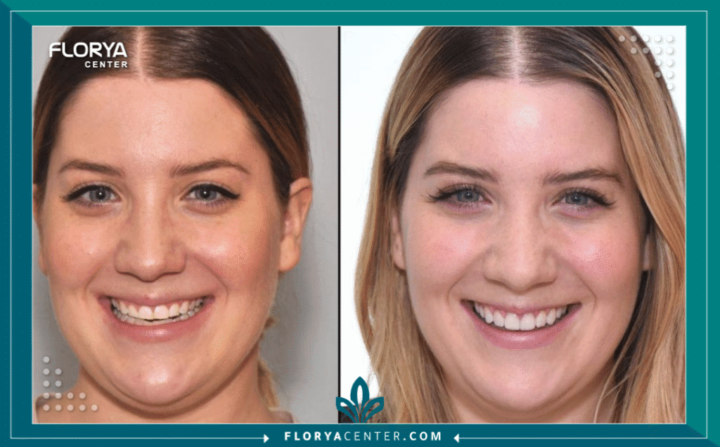 nouralagee93@gmail.com 20250714 102907 ٠٠٠٠ - فينير الأسنان يُعد فينير الأسنان (Dental Veneers) الحل التجميلي الأكثر طلباً وثورية في عالم طب الأسنان الحديث، فهو يمثل الطريق الأسرع والأكثر فعالية للحصول على ابتسامة متناسقة، ناصعة البياض، وجذابة، والتي تُعرف عالمياً باسم "ابتسامة هوليوود". لا يقتصر دور فينير الأسنان على تبييض الأسنان فحسب، بل هو إجراء دقيق يعيد نحت وتصميم شكل الابتسامة بالكامل، مما يمنحك تغييراً جذرياً في مظهرك وثقتك بنفسك. سواء كنت تعاني من تصبغات عميقة، أسنان غير متساوية، فراغات بسيطة، أو تشققات، فإن فينير الأسنان يقدم حلاً دائماً وفعالاً.