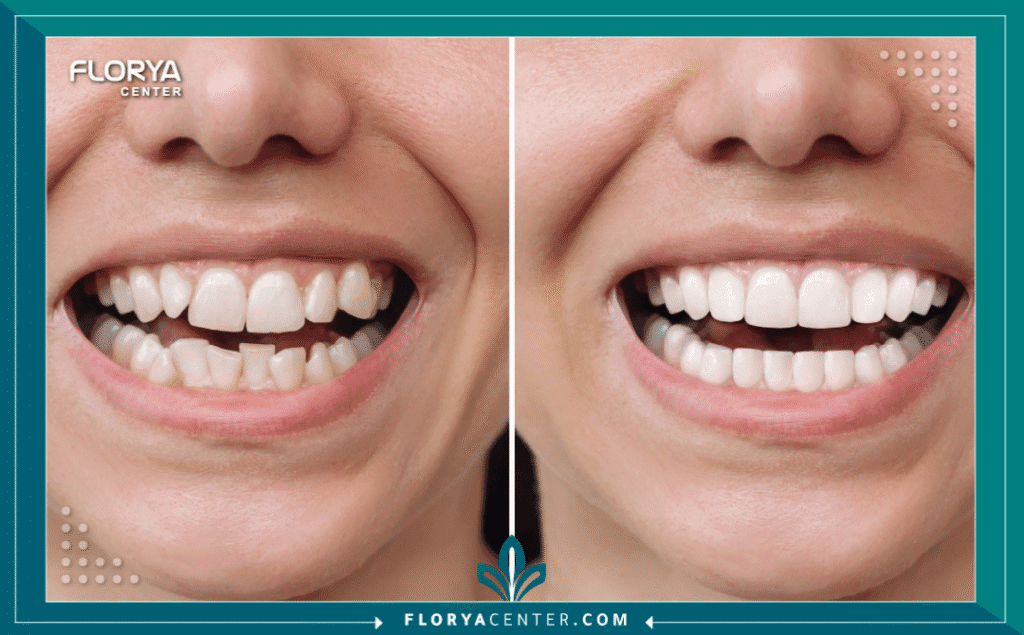 nouralagee93@gmail.com 20250714 103016 ٠٠٠٠ - فينير الأسنان يُعد فينير الأسنان (Dental Veneers) الحل التجميلي الأكثر طلباً وثورية في عالم طب الأسنان الحديث، فهو يمثل الطريق الأسرع والأكثر فعالية للحصول على ابتسامة متناسقة، ناصعة البياض، وجذابة، والتي تُعرف عالمياً باسم "ابتسامة هوليوود". لا يقتصر دور فينير الأسنان على تبييض الأسنان فحسب، بل هو إجراء دقيق يعيد نحت وتصميم شكل الابتسامة بالكامل، مما يمنحك تغييراً جذرياً في مظهرك وثقتك بنفسك. سواء كنت تعاني من تصبغات عميقة، أسنان غير متساوية، فراغات بسيطة، أو تشققات، فإن فينير الأسنان يقدم حلاً دائماً وفعالاً.