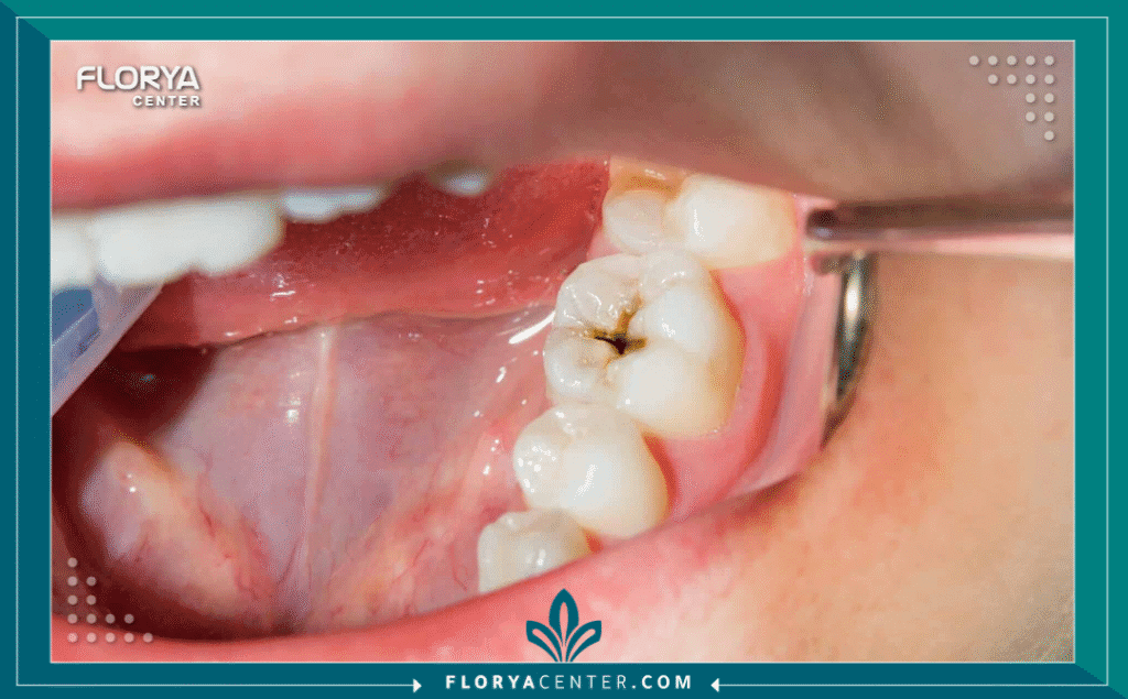 nouralagee93@gmail.com 20250715 120823 ٠٠٠٠ - كيف نمنع تسوس الأسنان؟ إن الإجابة عن سؤال كيف نمنع تسوس الأسنان؟ (How to prevent tooth decay?) تبدأ بفهم أنه أحد أكثر الأمراض المزمنة شيوعاً في العالم، ولكنه أيضاً الأكثر قابلية للمنع. تسوس الأسنان، المعروف علمياً باسم "نخر الأسنان" (Dental Caries)، ليس مجرد "حفرة" تظهر فجأة؛ بل هو عملية مرضية معقدة تحدث ببطء وتتغذى على عاداتنا اليومية. إنه مرض بكتيري ناتج عن الأحماض التي تفرزها البكتيريا المقيمة في الفم بعد استهلاكها للسكريات والنشويات التي نتناولها، مما يؤدي إلى تآكل طبقة المينا الصلبة للأسنان.