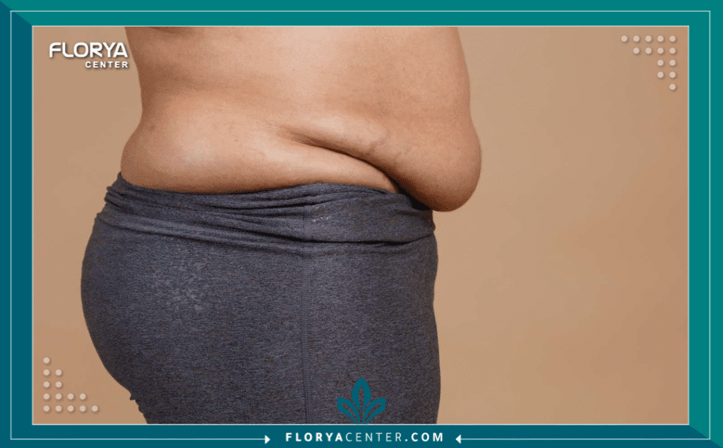 nouralagee93@gmail.com 20250715 150151 ٠٠٠٠ - ترهل البطن يُعد ترهل البطن أحد أكثر التحديات الجمالية والوظيفية إحباطاً للرجال والنساء على حدٍ سواء، وغالباً ما يكون نتيجة طبيعية لتغيرات كبيرة في الحياة مثل الحمل، فقدان الوزن الهائل، أو التقدم الطبيعي في العمر. هذه الحالة، التي تتجاوز مجرد تراكم الدهون، لتشمل جلداً زائداً وعضلات بطن ضعيفة، قد لا تستجيب للتمارين الرياضية أو الحميات الغذائية مهما كانت قاسية. لكن استعادة مظهر البطن المشدود والمسطح ليست حلماً بعيد المنال. ففي عالم الجراحة التجميلية المتقدمة، يُقدم إجراء شد البطن (Abdominoplasty) حلاً جذرياً وفعالاً، وهو مجال تتألق فيه تركيا كوجهة رائدة، مقدمةً نتائج تغير حياة الآلاف الباحثين عن استعادة الثقة بمظهرهم.