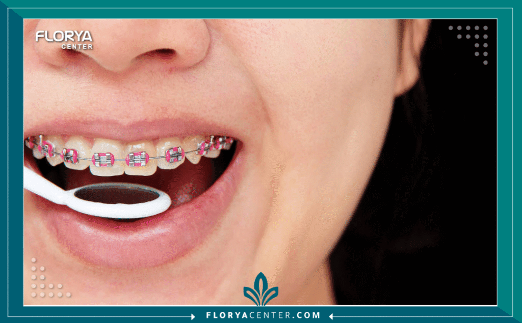 تكلفة تقويم الأسنان في تركيا