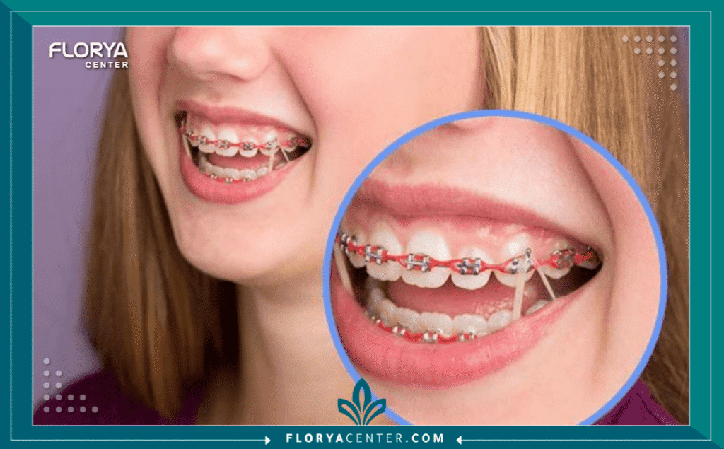 nouralagee93@gmail.com 20250716 165148 ٠٠٠٠ - تكلفة تقويم الأسنان في تركيا هل تحلم بابتسامة مثالية تمنحك الثقة وتغير مجرى حياتك، لكنك تقف حائراً أمام الأسعار الباهظة في بلدك؟ إن تكلفة تقويم الأسنان في تركيا (Dental Braces Cost in Turkey) أصبحت اليوم المعادلة الذهبية التي تجمع بين الجودة الطبية العالمية والأسعار الاقتصادية المدروسة. في عالم تجميل الأسنان، لم تعد الرحلة العلاجية مجرد رفاهية، بل ضرورة طبية واستثمار طويل الأمد في صحتك. تخيل أن تحصل على علاج تقويم أسنان بأحدث التقنيات العالمية، مع توفير يصل إلى 70% مقارنة بأوروبا وأمريكا، كل ذلك بينما تستمتع بجمال إسطنبول الساحر. في هذا الدليل، لن نبيعك الوهم، بل سنضع بين يديك خارطة طريق مالية وطبية دقيقة لعام 2026.