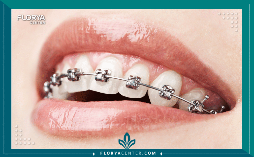 nouralagee93@gmail.com 20250718 143746 ٠٠٠٠ - مدة علاج تقويم الأسنان تعتبر مدة علاج تقويم الأسنان (Orthodontic Treatment Duration) أول سؤال يطرحه المريض، وهو السؤال الأكثر أهمية بعد التكلفة. يمثل تقويم الأسنان استثماراً كبيراً في الوقت والجهد، لا يهدف فقط إلى الحصول على ابتسامة جميلة ومتناسقة، بل يهدف بشكل أساسي إلى تصحيح الإطباق وتحسين وظائف المضغ والنطق، والحفاظ على صحة الفم والأسنان على المدى الطويل.