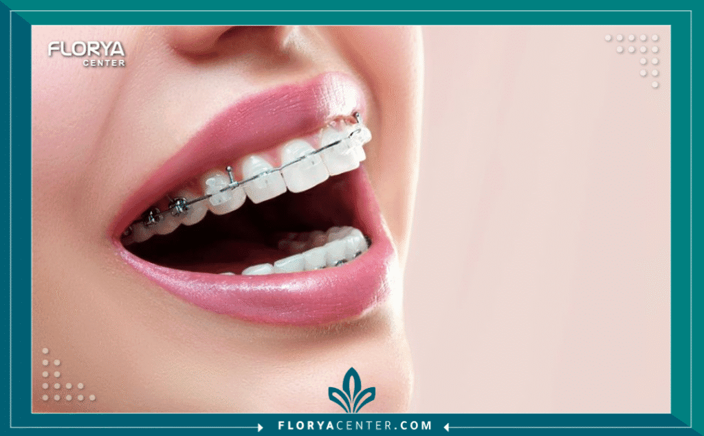 nouralagee93@gmail.com 20250720 113922 ٠٠٠٠ - العناية بالأسنان أثناء التقويم تعتبر العناية بالأسنان أثناء التقويم (Orthodontic Dental Care) التحدي الأكبر والضمان الأوحد لنجاح رحلة الحصول على ابتسامة مستقيمة وصحية. إن تركيب تقويم الأسنان، سواء كان معدنياً أو شفافاً، هو استثمار كبير في مستقبلك الجمالي والصحي، لكن هذا الاستثمار يظل ناقصاً تماماً بدون التزام صارم بالنظافة الفموية.